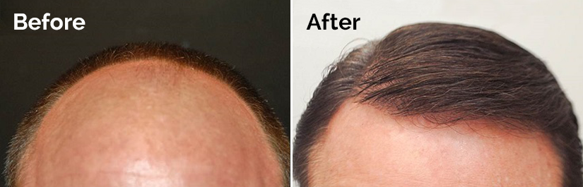 Hair restoration is still a possibility for those suffering from alopecia.