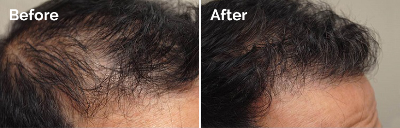 Before and after of NeoGraft reducing a balding area.