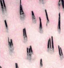 Hair follicle transplant is safer with NeoGraft compared to traditional hair loss remedies