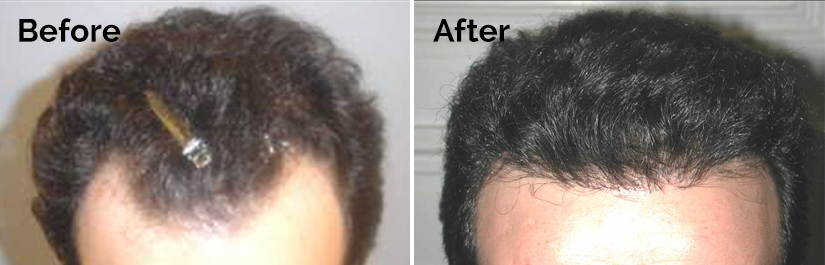 NeoGraft Before and After photo