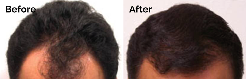 NeoGraft Before and After photo