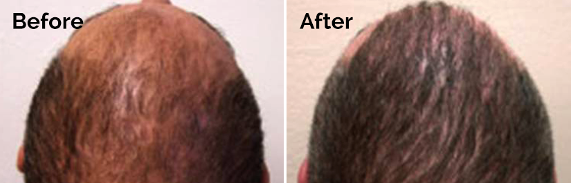 NeoGraft Before and After photo