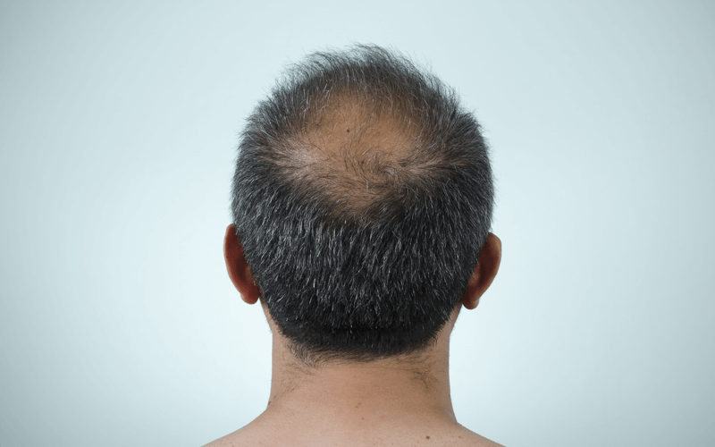Back view of man with male pattern baldness, or androgenetic alopecia