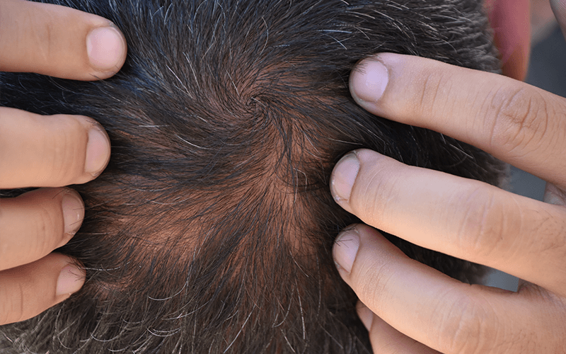 Man feeling the thinning hair on his scalp.